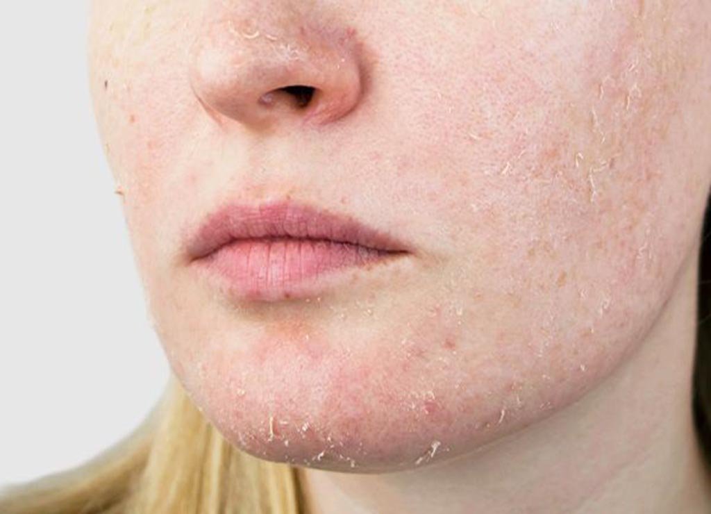 چه علائمی نشانه خشکی پوست است؟