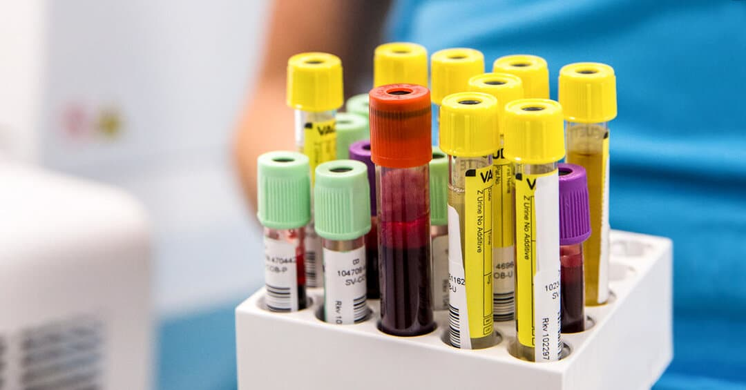 مهمترین انواع آزمایش خون