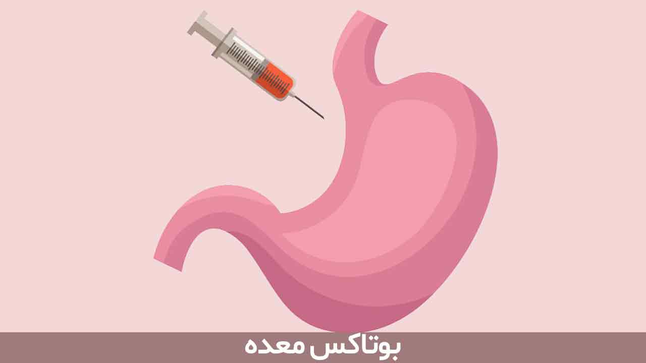 همه چیز درباره ی بوتاکس معده