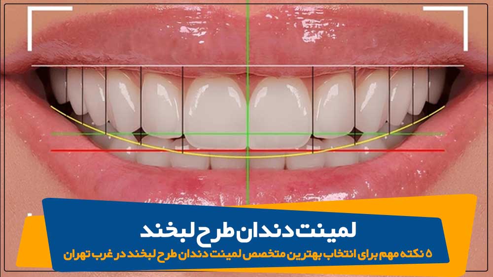 لمینت دندان در غرب تهران لمینت دندان طرح لبخند